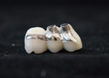 Cementable-Implant-Bridge-700-x-500
