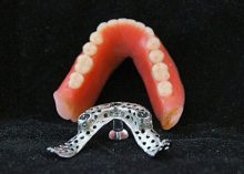 Locator3-Finished-Overdenture-72-500-x-400